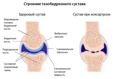У формуванні тазостегнового суглоба беруть участь дві сочленяющиеся кістки: стегнова і клубова