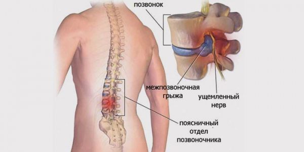 Міжхребцева грижа - це своєрідне випадання, виділення частин міжхребцевого диска в спинному хребті